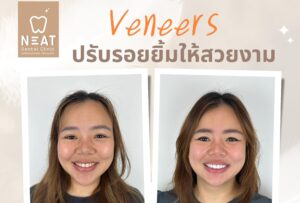 ceramic veneer