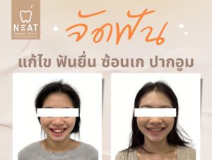 จัดฟัน